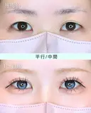 エターナル二重術(自然癒着法) before画像 サムネイル用