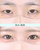 エターナル二重術(自然癒着法) after画像 サムネイル用