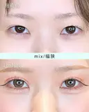 エターナル二重術(自然癒着法) before画像 サムネイル用