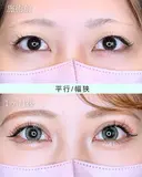 エターナル二重術(自然癒着法) after画像 サムネイル用