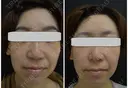 IPL（光治療）　1回 before画像 サムネイル用