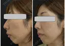 IPL光治療　1回 14日後 サムネイル用