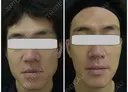 ケミカルピーリング＋エレクトロポレーション（Taプラス）3回＋イソトレチノイン3ヶ月 before画像 サムネイル用