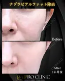 ナゾラビアルファット除去 after画像 サムネイル用
