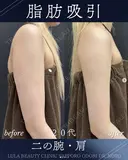 二の腕+肩　脂肪吸引 before画像 サムネイル用