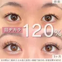 1週間でもう可愛い♡MD式全切開法二重術+MD式眼瞼下垂手術※たるみ取り併用 before画像 サムネイル用
