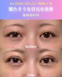 【施術直後】切らない眼瞼下垂 0日後 サムネイル用