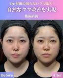 【施術直後】切らないクマ取り before画像 サムネイル用