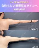 二の腕＋肩脂肪吸引 7日後 サムネイル用