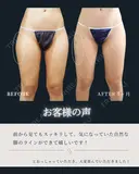 韓国アイドルのような美脚に！✨💓 after画像 サムネイル用