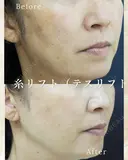 糸リフト（テスリフト） after画像 サムネイル用