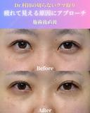 【施術直後】切らないクマ取り 0日後 サムネイル用