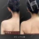 肩ボトックス before画像 サムネイル用