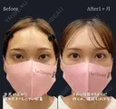 目尻靭帯移動＋目尻切開 before画像 サムネイル用