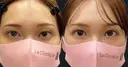 目尻靭帯移動＋目尻切開 after画像 サムネイル用
