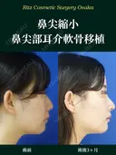 鼻尖形成＋鼻尖部耳介軟骨移植 after画像 サムネイル用