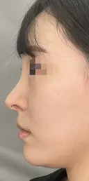 耳介軟骨移植+鼻尖形成 90日後 サムネイル用