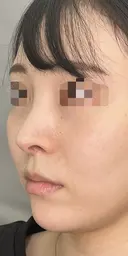 耳介軟骨移植+鼻尖形成 90日後 サムネイル用