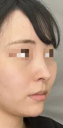 耳介軟骨移植+鼻尖形成 90日後 サムネイル用