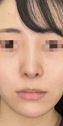 耳介軟骨移植+鼻尖形成 90日後 サムネイル用