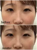 涙袋ヒアルロン酸 before画像 サムネイル用