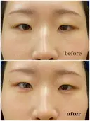 涙袋ヒアルロン酸 before画像 サムネイル用