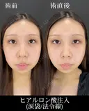 ヒアルロン酸注入（涙袋/法令線） before画像 サムネイル用