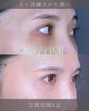 目頭切開Z法 after画像 サムネイル用