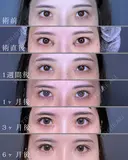 目頭切開Z法 after画像 サムネイル用