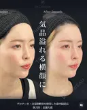 鼻フル（プロテーゼ＋鼻先grade３） after画像 サムネイル用
