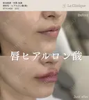 唇ヒアルロン酸 before画像 サムネイル用