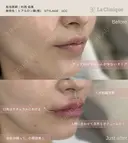 唇ヒアルロン酸 after画像 サムネイル用