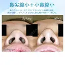 【20代女性・ダンゴ鼻＆大きな小鼻】鼻尖縮小術+α法＆小鼻縮小術+α法 before画像 サムネイル用