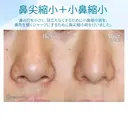 【20代女性・ダンゴ鼻＆大きな小鼻】鼻尖縮小術+α法＆小鼻縮小術+α法 after画像 サムネイル用