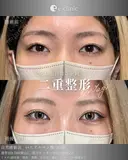 二重整形×涙袋 after画像 サムネイル用