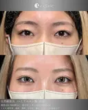 二重整形×涙袋 before画像 サムネイル用