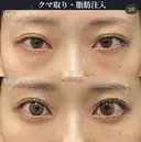 🧸切らない目の下たるみ取り・脂肪注入 after画像 サムネイル用
