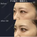🧸切らない目の下たるみ取り・脂肪注入 before画像 サムネイル用