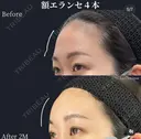 額エランセ　（デコンセ） before画像 サムネイル用