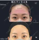 額エランセ　（デコンセ） after画像 サムネイル用