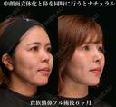 貴族猫鼻フル 180日後 サムネイル用