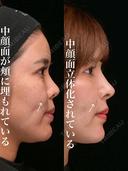 貴族猫鼻フル 180日後 サムネイル用