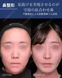 肋軟骨鼻フル before画像 サムネイル用