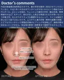 肋軟骨鼻フル 30日後 サムネイル用