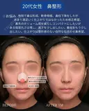 肋軟骨鼻フル 30日後 サムネイル用