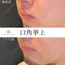 口角挙上 30日後 サムネイル用