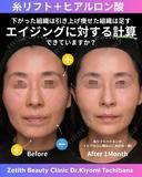 糸リフト+ヒアルロン酸 30日後 サムネイル用