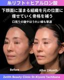 糸リフト+ヒアルロン酸 30日後 サムネイル用