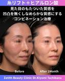 糸リフト+ヒアルロン酸 30日後 サムネイル用