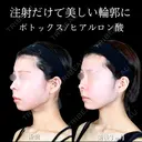 エラボトックス/顎ヒアルロン酸 90日後 サムネイル用